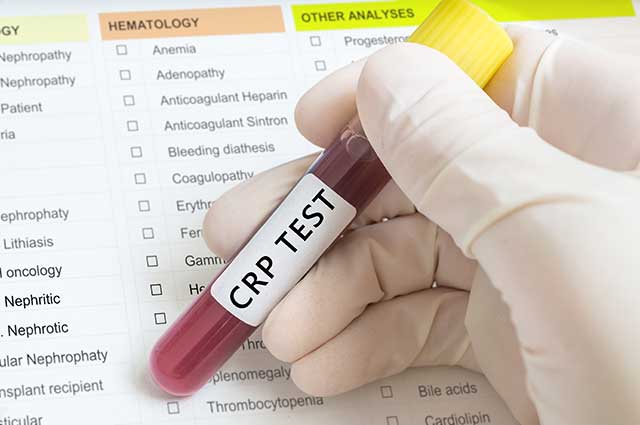 Blood Sample For CRP Test.