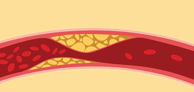 Diagram Showing Vascular Calcification In a Blood Vessel.