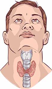 Illustration Showing a Man With An Enlarged Thyroid.