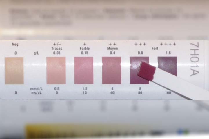 Diastix Reagent Strips For Urinalysis Color Chart