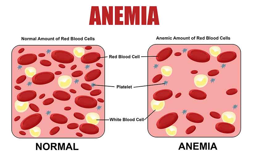 Diagram Showing How Iron Deficiency Anemia Works.