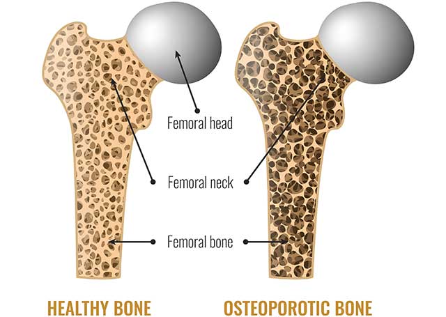 Diagram Showing the Differences Between Healthy Bone and Osteoporotic Bone.
