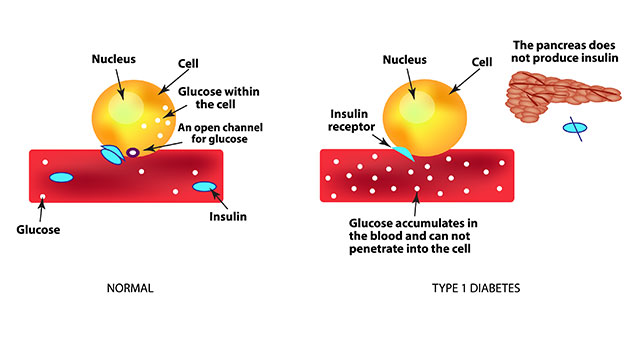 Diagram Showing What Happens Biologically With Type 1 Diabetes.