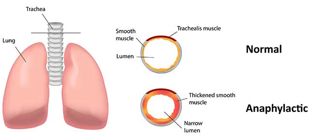 Diagram Illustrating the Effects of Anaphylactic Shock.