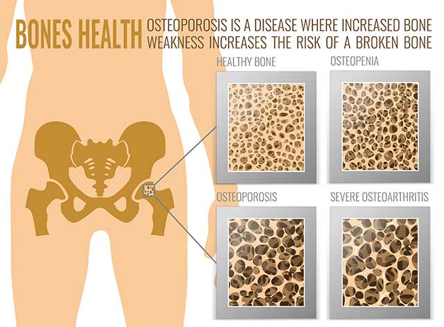 Diagram Showing Bone Health and the Four Stages of Osteoporosis.