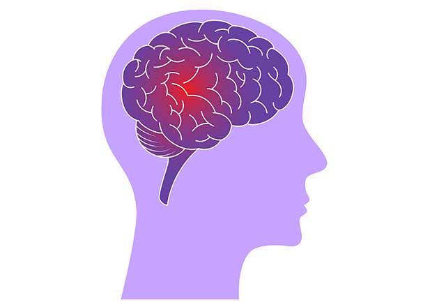 Illustration of Brain With Epilepsy.