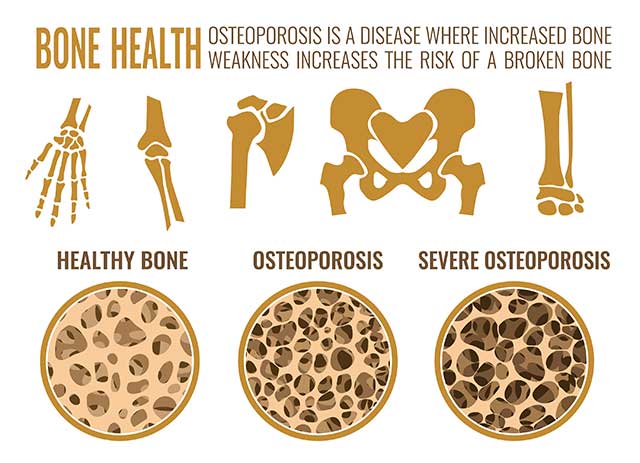 An Infographic Explaining What Osteoporosis Is and How It Develops.