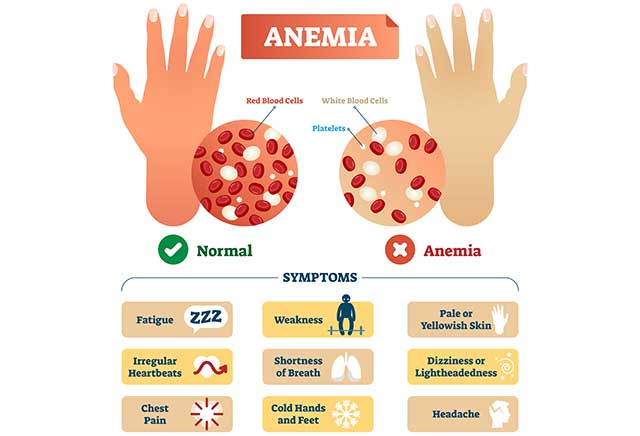 Infographic Showing the Symptoms of Iron Deficiency Anemia.