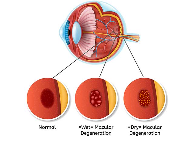 Infographic Showing How Macular Degeneration Progresses.