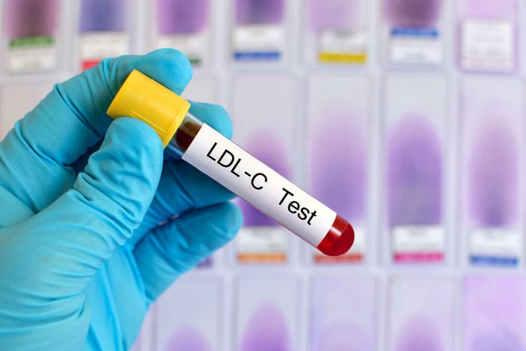 A Test Tube Containing Blood With 'LDL-C' on the Label.